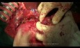 Whipple procedure for retroperitoneal tumor with duodenal fistula