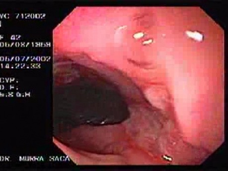 Crohn's Disease - Endoscopy (13 of 28)