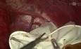 Hidatid Cyst