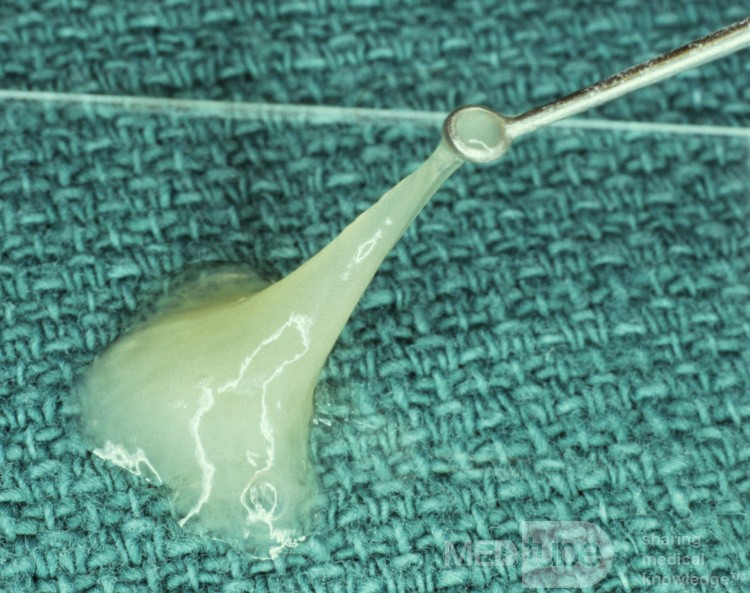 Mucoid Otitis Media [aspirate]