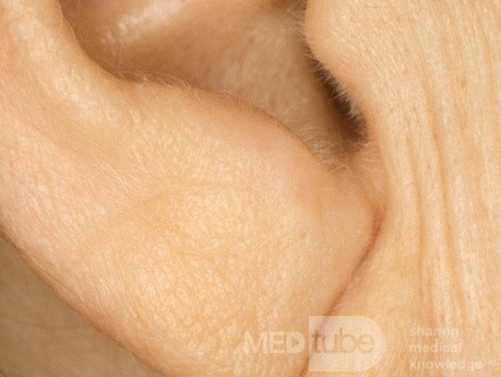 Creased Lobule