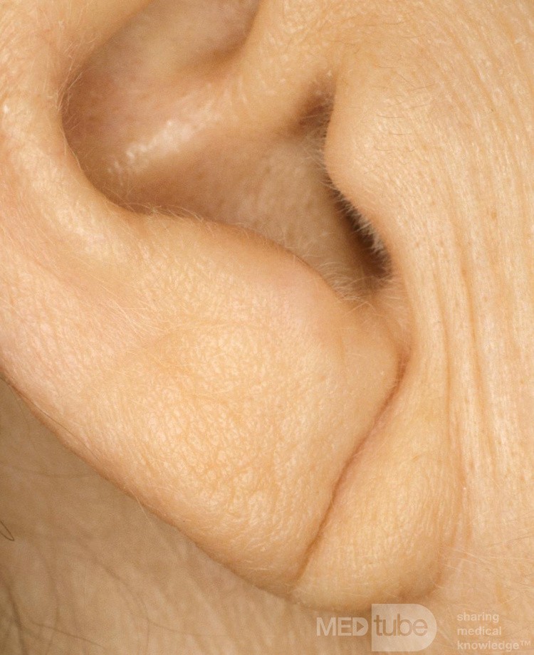 Creased Lobule