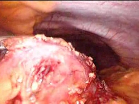 Gastrointestinal Stromal Tumor - GIST (37 of 65)