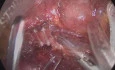 Colorectal Laparoscopic Extended Left Hemicolectomy with Complete Mesocolic Excision & Transverse Colon - Rectal Anastomosis With Derotation of the Right Colon for Splenic Flexure Carcinoma