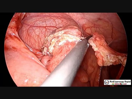 Laparoscopic Appendectomy for Acute Appendicitis in Pediatric Patient