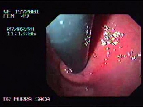 Esophageal Achalasia - Retroflexed View of Cardias After Maneuver in the Fundus
