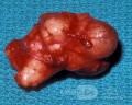 Mixed Tumor Parotid Gland