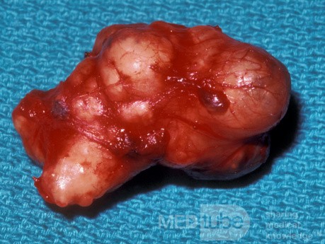 Mixed Tumor Parotid Gland