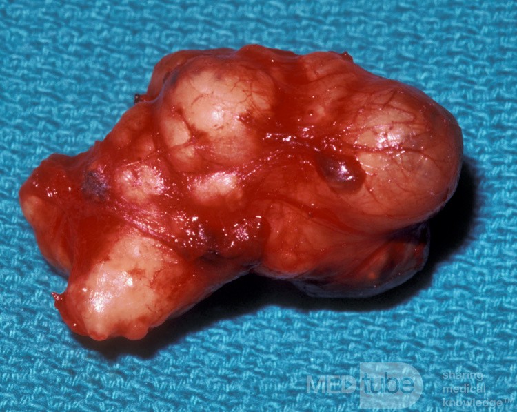 Mixed Tumor Parotid Gland