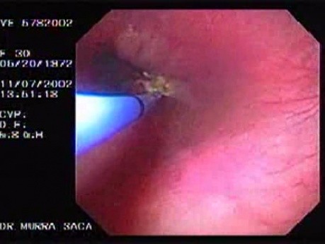 Evolution of a Gastric Carcinoma without a Treatment (8 of 10)
