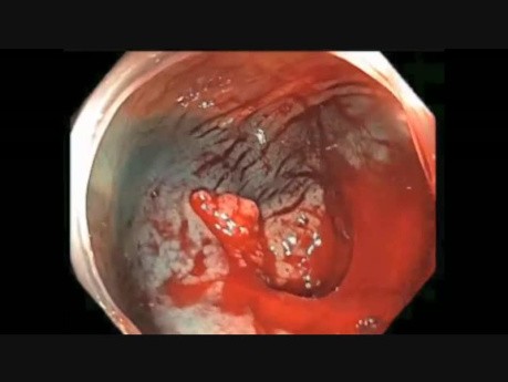 Colonoscopy Channel Quiz 11