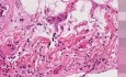 Metastatic breast carcinoma - Histopathology - Heart, pericardium