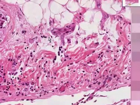 Metastatic breast carcinoma - Histopathology - Heart, pericardium