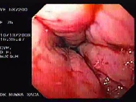 Esophageal Achalasia (15 of 16)