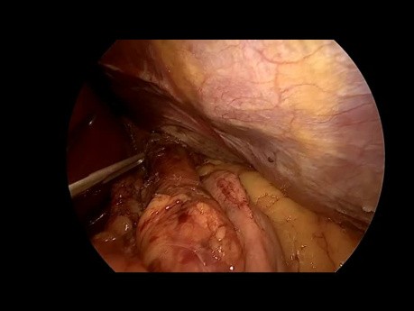 Nissen Surgery