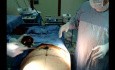 Tummy tuck surgery - body contouring