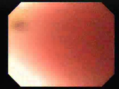 Achalasia - Residual Food - 50 Year-Old Lady