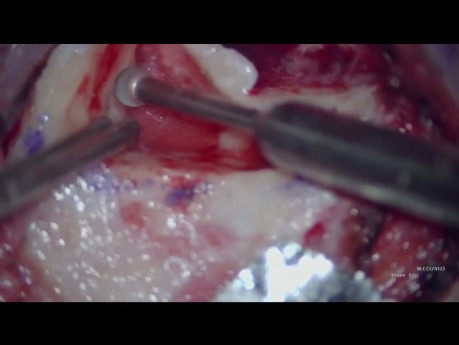 Cholesteatoma Surgery Combined Approach (Endoscopic and Microscopic)