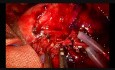 Uniportal VATS Vascular Anastomosis During Double Sleeve