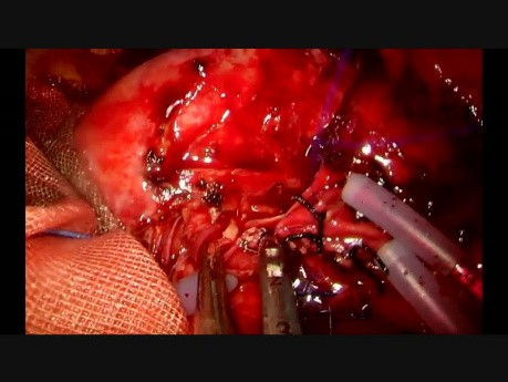 Uniportal VATS Vascular Anastomosis During Double Sleeve