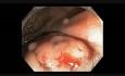 Colonoscopy Channel - EMR Of A Flat Lesion In The Low Rectum