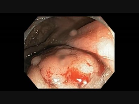 Colonoscopy Channel - EMR Of A Flat Lesion In The Low Rectum