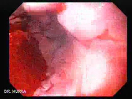 Esophageal Varix - Endoscopic Image of Bleeding