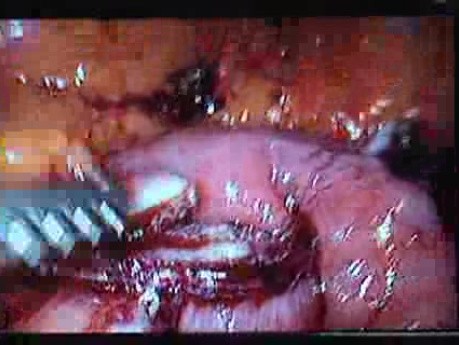 Jejunal Gastrointestinal Stromal tumor (GIST) (41 of 86)