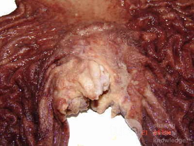 Adenocarcinoma of the cardias and gastric fundus with signet-ring cells (14 of 25)