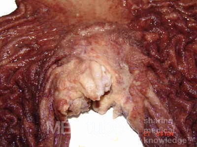Adenocarcinoma of the cardias and gastric fundus with signet-ring cells (14 of 25)