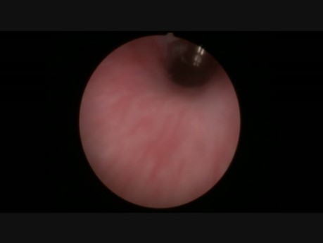 Foreign Body per Urethra