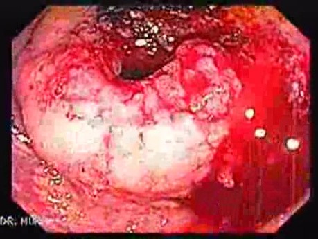 Rectal Adenocarcinoma (1 of 12)