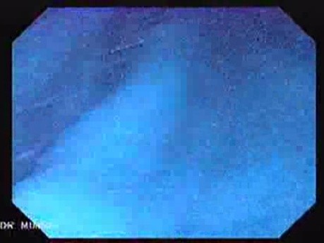 Gastric Folds - Immersion Endoscopy (6 of 8)