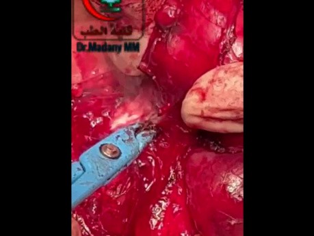Ligament of Berry Release During Thyroidectomy