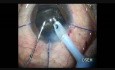 Traumatic Hard Cataract With Weak Zonules