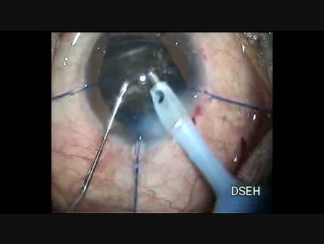 Traumatic Hard Cataract With Weak Zonules
