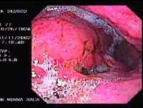 Gastric Adenocarcinoma That Has Been Manifested With Hiccups