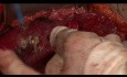 Surgical Aspects of Pseudomyxoma Peritonei