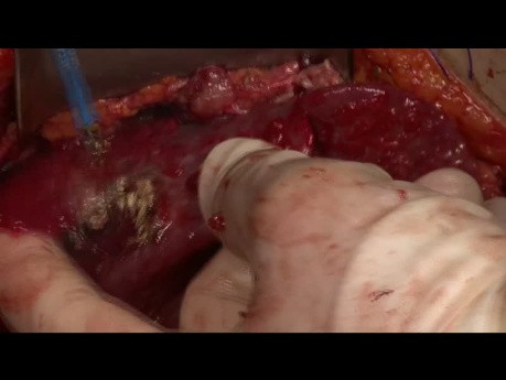 Surgical Aspects of Pseudomyxoma Peritonei