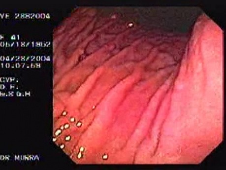 Multiple Gastric Polyps - Body and Fundus