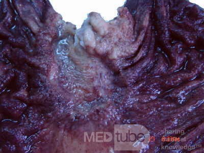Adenocarcinoma of the cardias and gastric fundus with signet-ring cells (17 of 25)