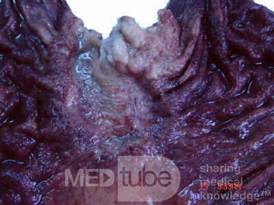 Adenocarcinoma of the cardias and gastric fundus with signet-ring cells (17 of 25)