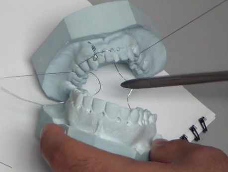 Jaw Fracture - Embrasure Wires