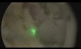 Laser Enucleation of the Prostate (HoLEP)