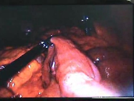 Jejunal Gastrointestinal Stromal tumor (GIST) (20 of 86)