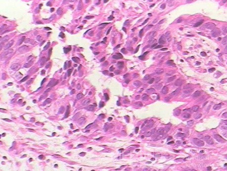 Barrett Adenocarcinoma - Endoscopic Image  (6 of 20)