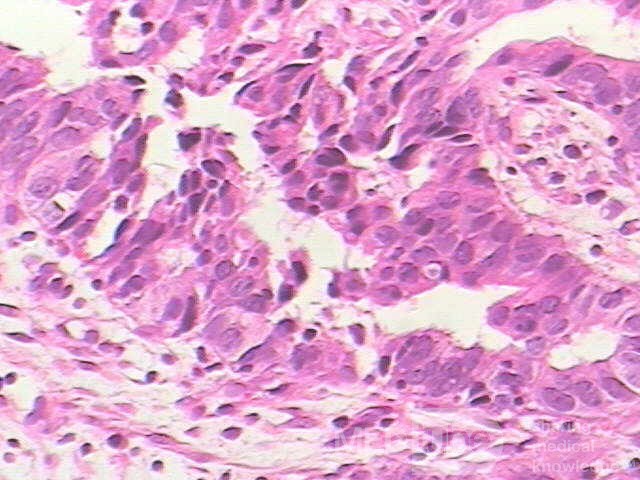 Barrett Adenocarcinoma - Endoscopic Image  (6 of 20)