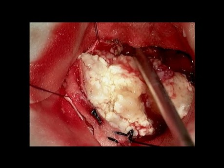 Posterior fossa meningioma