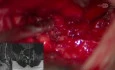 Minimally Invasive Removal of a Massive L5–S1 Disc Protrusion with Interbody Stabilization (TLIF)