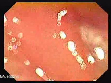 Colonic Tuberculosis Mimicking Crohn's Disease (2 of 12)